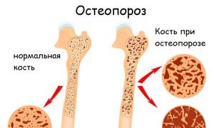 Как называется болезнь костей Воспаление костей и суставов как называется